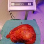 Ospedale dell’Annunziata di Cosenza: asportata massa tumorale da 4 chilogrammi