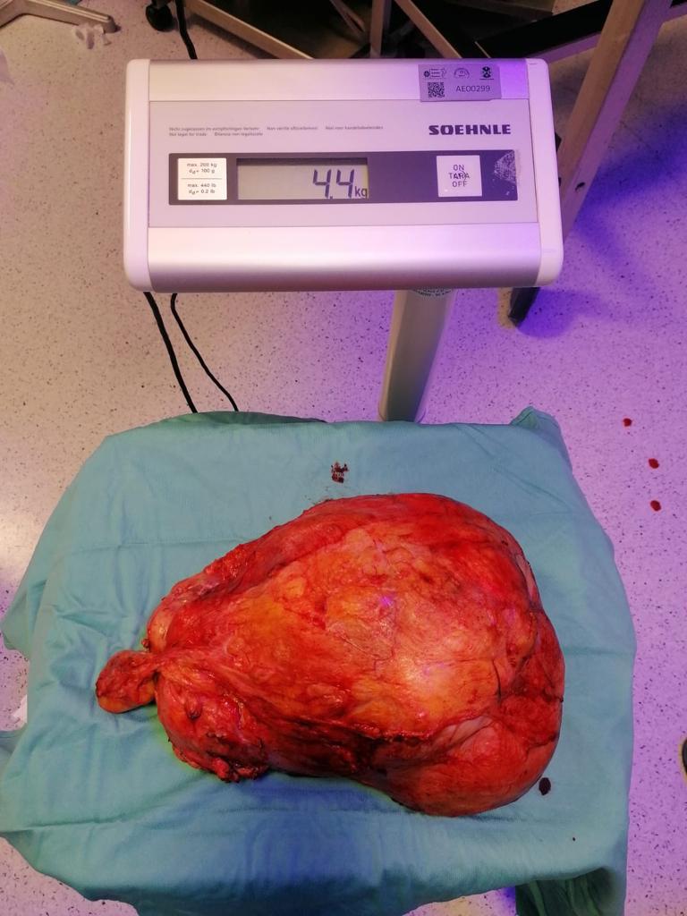 Ospedale dell’Annunziata di Cosenza: asportata massa tumorale da 4 chilogrammi